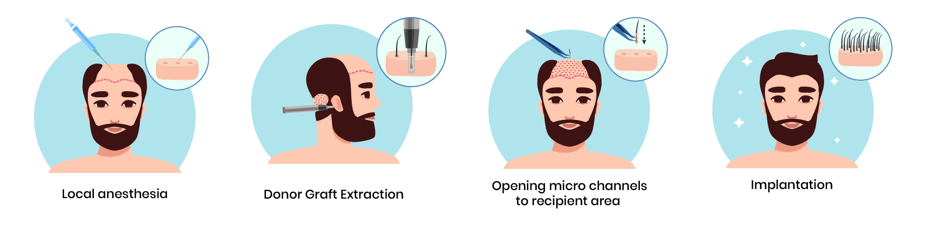 FUE Hair Transplant Technique, Method at 